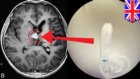 Tapeworm Infection Rare Brain Worm Took 4 Years To Crawl Across Uk Mans Brain Youtube