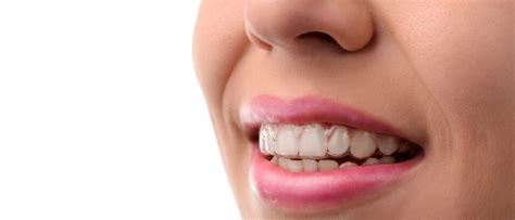 Another way to say more clear? Five Tips for Clear Aligner Comfort