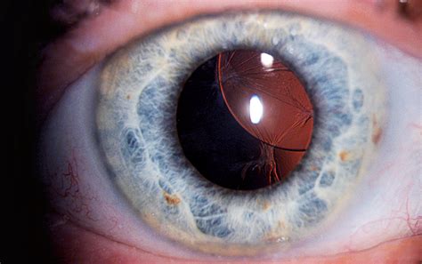 Retained Lens Fragments Dislocated Intraocular Lenses And Sutured