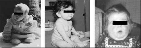 A C Showing The Phenotype Of Three Children With Congenital Gh