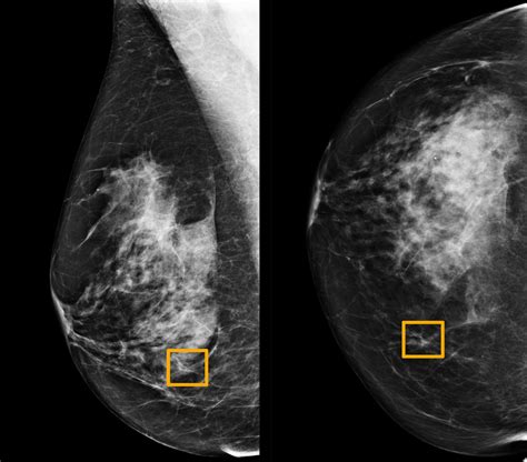 Ai Is Learning To Read Mammograms The New York Times