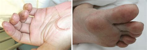 Figure1erythematous Macules On The Palms And Soles Janeway Lesions