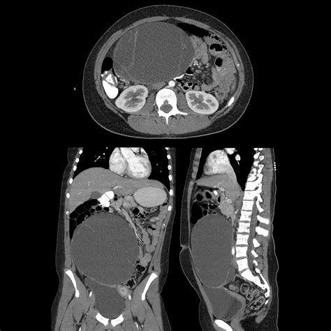 Female School Ager With Abdominal Pain Pediatric Radiology Case