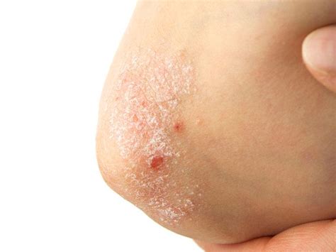 Disordini autoimmuni della pelle tra i cani causano una serie di sintomi. Sintomi della psoriasi: diagnosi e trattamento della ...