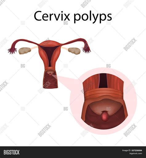 Cervix Polyps Image Photo Free Trial Bigstock