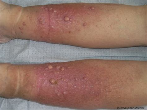 Chronic Venous Insufficiency From A Dermatological Perspective Elena