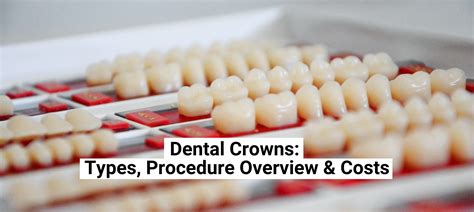 Dental Crowns Types Procedure Overview Costs The Teeth Blog