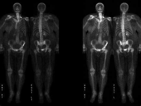 Exported PATHOLOGIC FRACTURE
