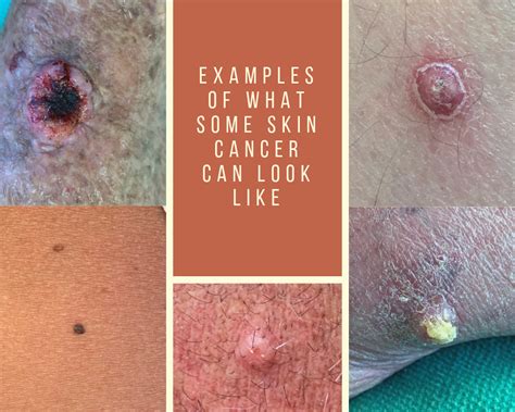 What Does Skin Cancer Look Like Healthy Living Images