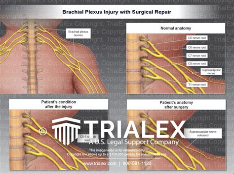 Brachial Plexus Surgery Plexus Products Brachial Surgery Images And