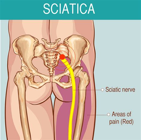 Can Pt Help Sciatica Momentum Physical Therapy