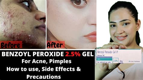 Benzoyl Peroxide Uses And Side Effects Gel For Ance Pimples Clogged Pores Breakouts