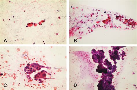 Cytopathology Of Micropapillary Carcinoma Samples Obtained From