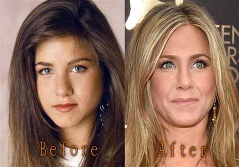 Jennifer joanna aniston is an american actress, producer, and businesswoman. Jennifer Aniston Plastic Surgery Boob, Nose Job Before and ...