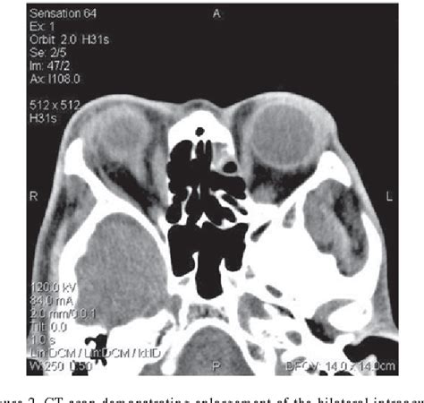 Figure 1 From Graves Disease Induced By Radiotherapy For