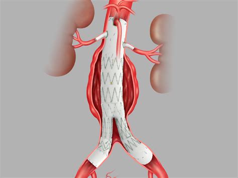 Zenith® Fenestrated Aaa Endovascular Graft Proximal Body Cook Medical