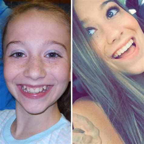 114 Incredible Before And After Transformations Of People Who Wore Braces Braces Tips Braces