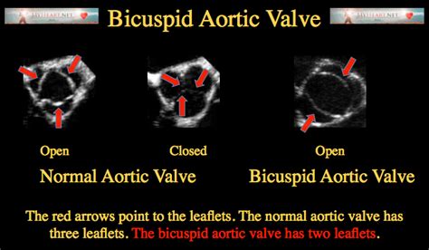 Bicuspid Aortic Valve Symptoms Diagnosis And Treatment