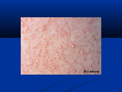 Infectious Disease Skin Rash