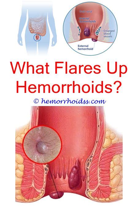 The most common symptom of hemorrhoids is blood covering your stool, blood on the toilet paper when you wipe, pain when you have a bowel movement or hard. Super Genius Tips: Can You Have Internal Hemorrhoids That ...