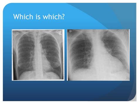 Ppt Chest X Ray Interpretation For The Internist Powerpoint