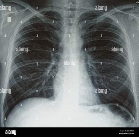 Plain Chest X Ray Normal Healthy Lungs Black And White Stock Photo