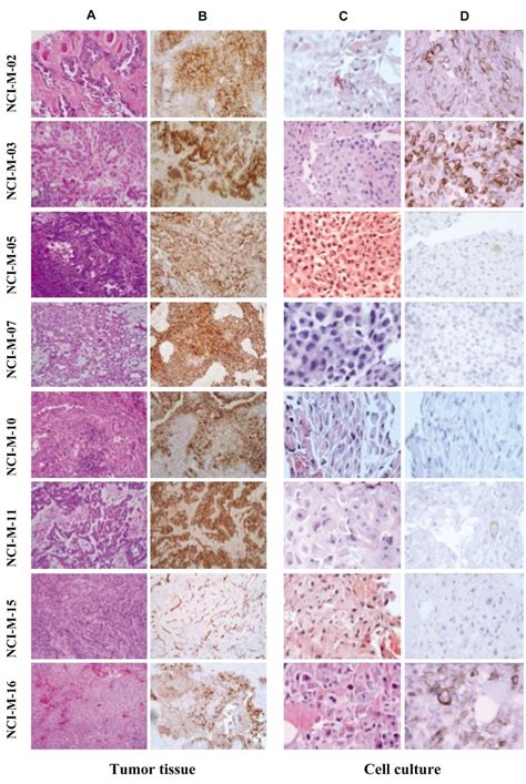 Loss Of Mesothelin Expression By Mesothelioma Cells Grown In Vitro
