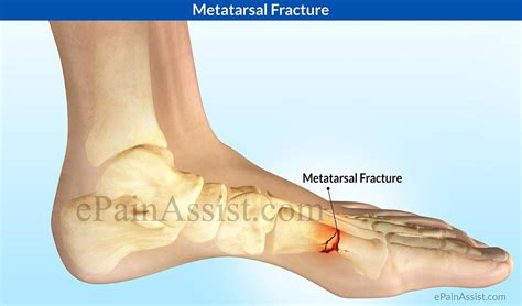 Image Gallery Metatarsal Fracture