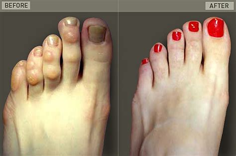 Hammer Toe Before And After