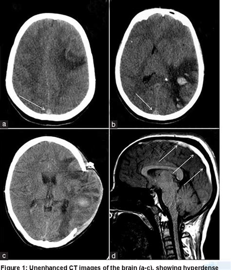 Figure 1 From A Rare Cause Of Dural Venous Sinus Thrombosis Semantic