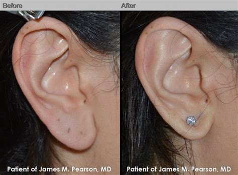 Earlobe Reduction By Dr James M Pearson Md Learn More At