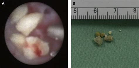 The Use Of Sialendoscopy For The Treatment Of Multiple Salivary Gland