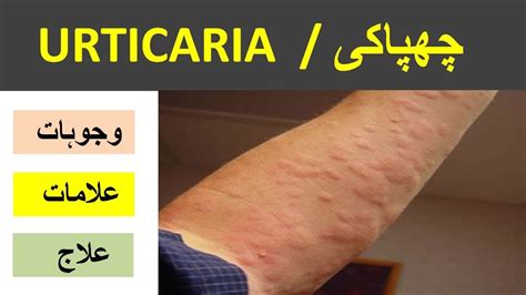Urticaria Treatment Causes Symptoms And Treatment Iqbal Health