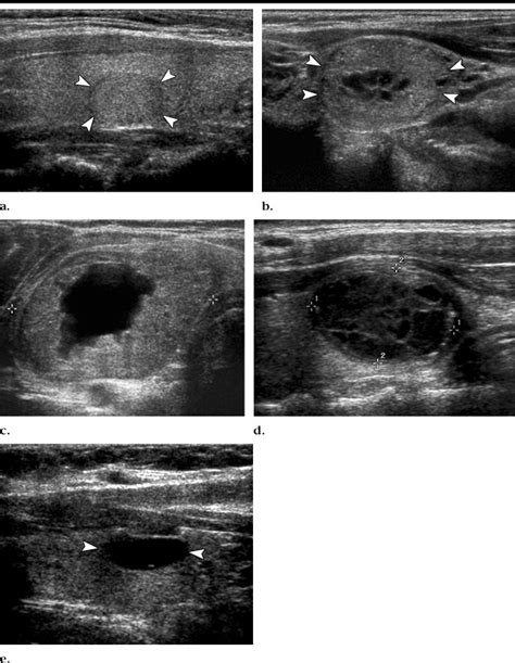 Us Images Of Thyroid Nodules Of Varying Parenchymal Composition Solid