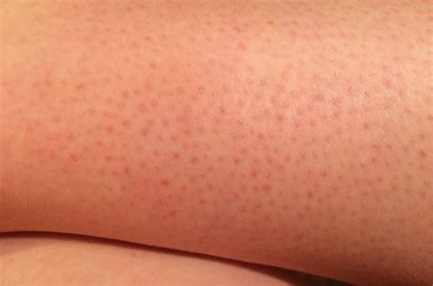 11 Causes Of Small Red Bumps On Legs Or Spots Skincarederm