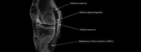 Medial Collateral Ligament Tear The Surrey Osteopaths