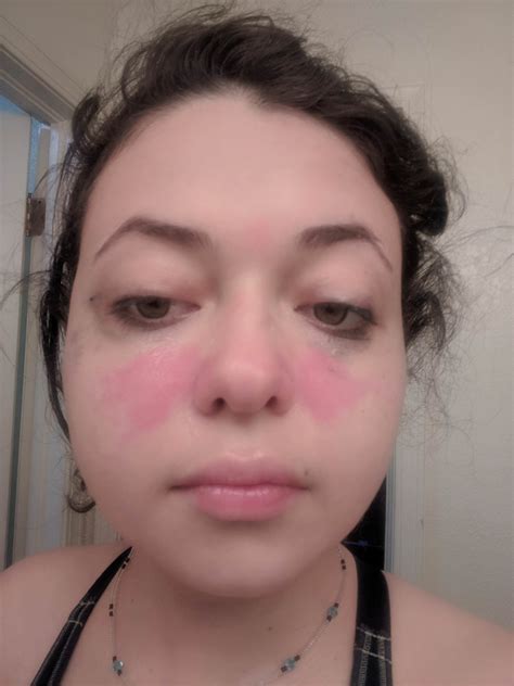 Lupus Butterfly Rash On Face