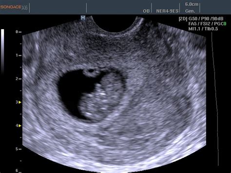 Medisonru Fetus 8 Weeks X6