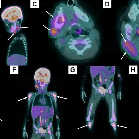 Positron Emission Tomography Computed Tomography Pet Ct Aspects Of