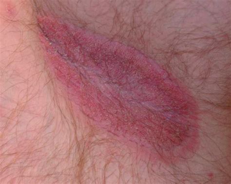 It will cause blisters or lesions on the affected area with burning. How to cure jock itch. Get rid of sweat rash with Sudocrem ...