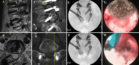 Transforaminal 360° Lumbar Endoscopic Foraminotomy In Postfusion Patients Technical Note And