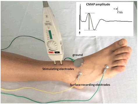 Validation Of The Peroneal Nerve Test To Diagnose F1000research