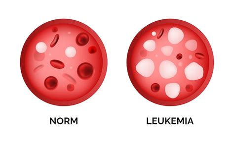 Premium Vector Infographic Image Of Leukemia Illustration