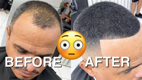 Before And After From Being Bald To Full Head Of Hair Youtube