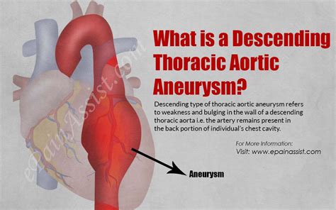 What Is A Descending Thoracic Aortic Aneurysm
