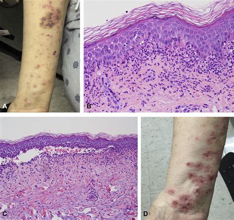 Linear Iga Bullous Dermatosis Protracted By Vancomycin Loaded Bone