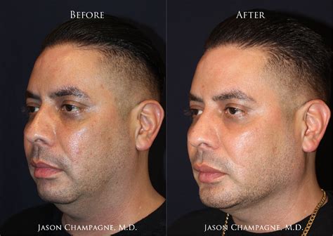 Obtain A Chiseled Look Custom Jaw And Chin Implants — Plastic Surgeon