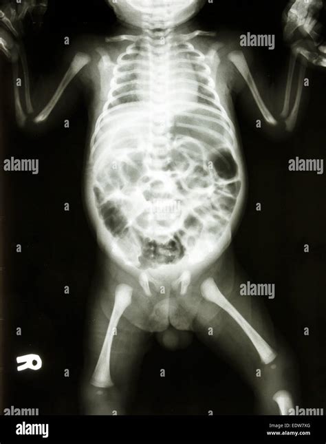 Normal Infant Chest Xray