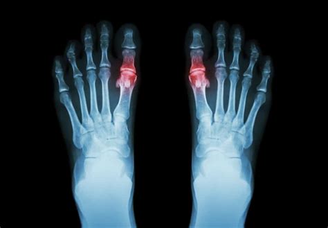 Metatarsal Fracture Causes Symptoms Treatments Surgery And Recovery