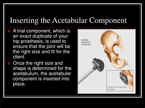 Ppt Total Hip Replacement Powerpoint Presentation Free Download Id